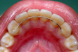 Metal Retainer