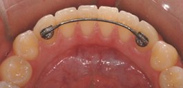 Hygienic Lower fixed retainer